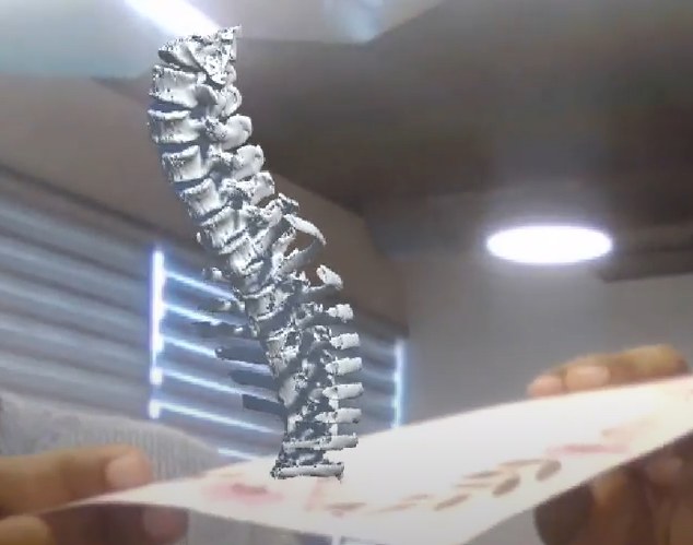 A 3D spinal column model generated from CT DICOM data, rendered in augmented reality above a printed marker card held in the user's hand.